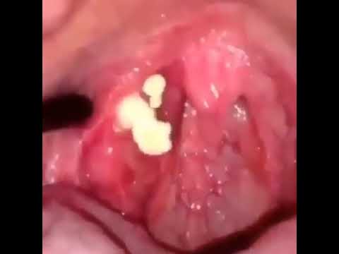 Pimple Popping Compilation Part #18 –  Pop this Tonsil Stones