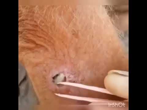 Pimple Popping Compilation Part # 14 – Cyst in The Hole