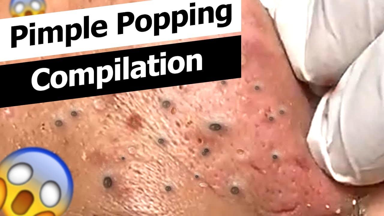 Pimple popping compilation // Pipmple popping videos // Pimple removing satisfying video