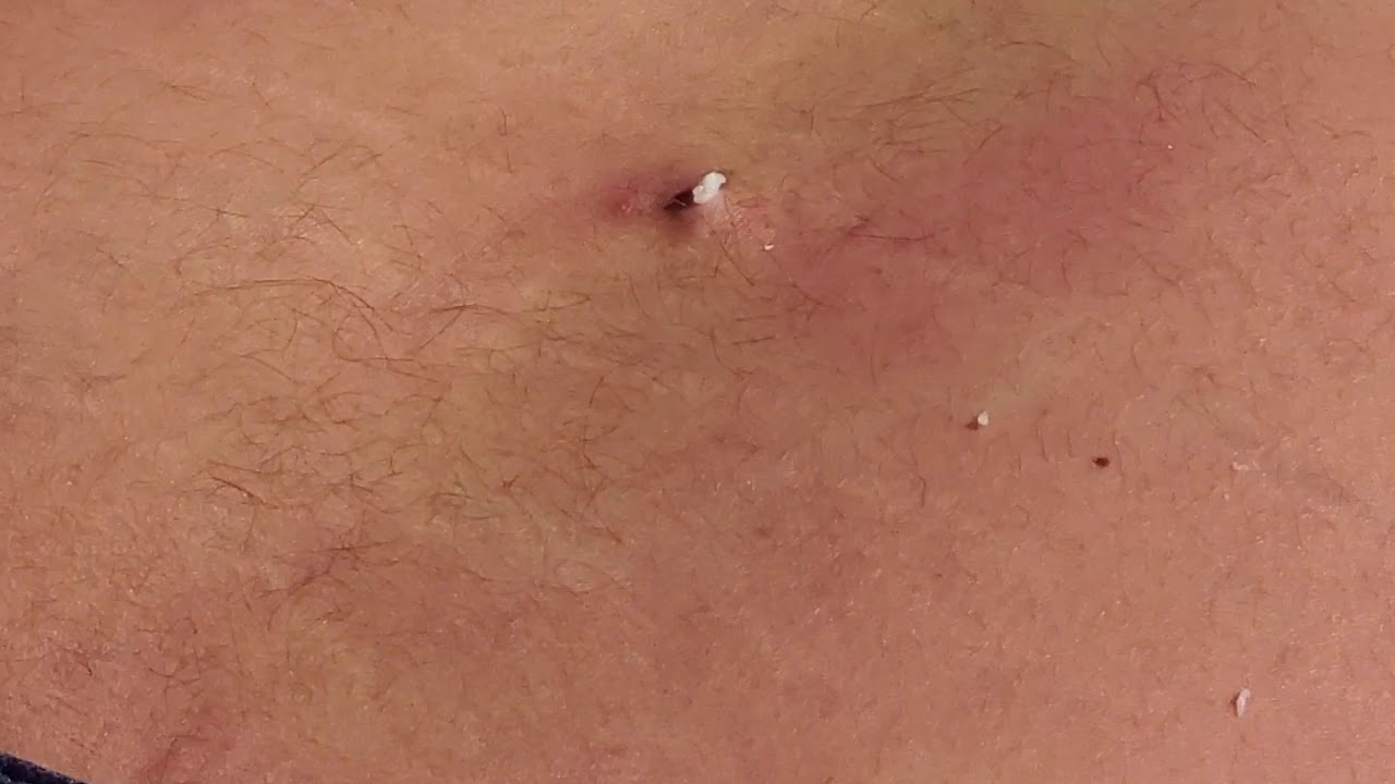 pimple popping cyst part 2