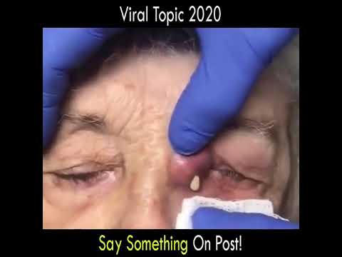 Pimple Popping, Cystic Acne, Blackhead Compilation – Skincare