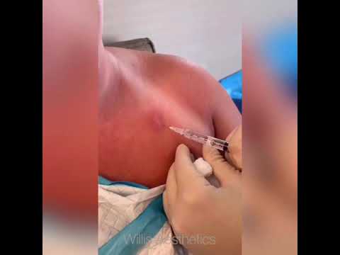 Pimple popping! Drainage of an infected sebaceous cyst-WARNING: surgical procedure with PUS ??