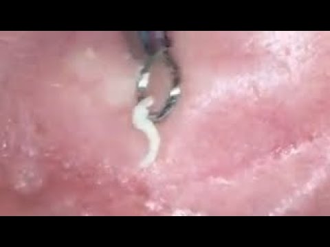 Pimple popping -?ear