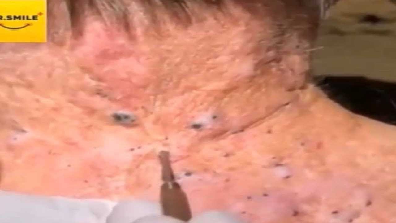 Pimple Popping End Game!  Cysts, Pimples, Dermatology and Blackhead Removal