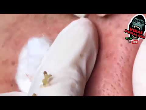 Pimple popping ? EP1