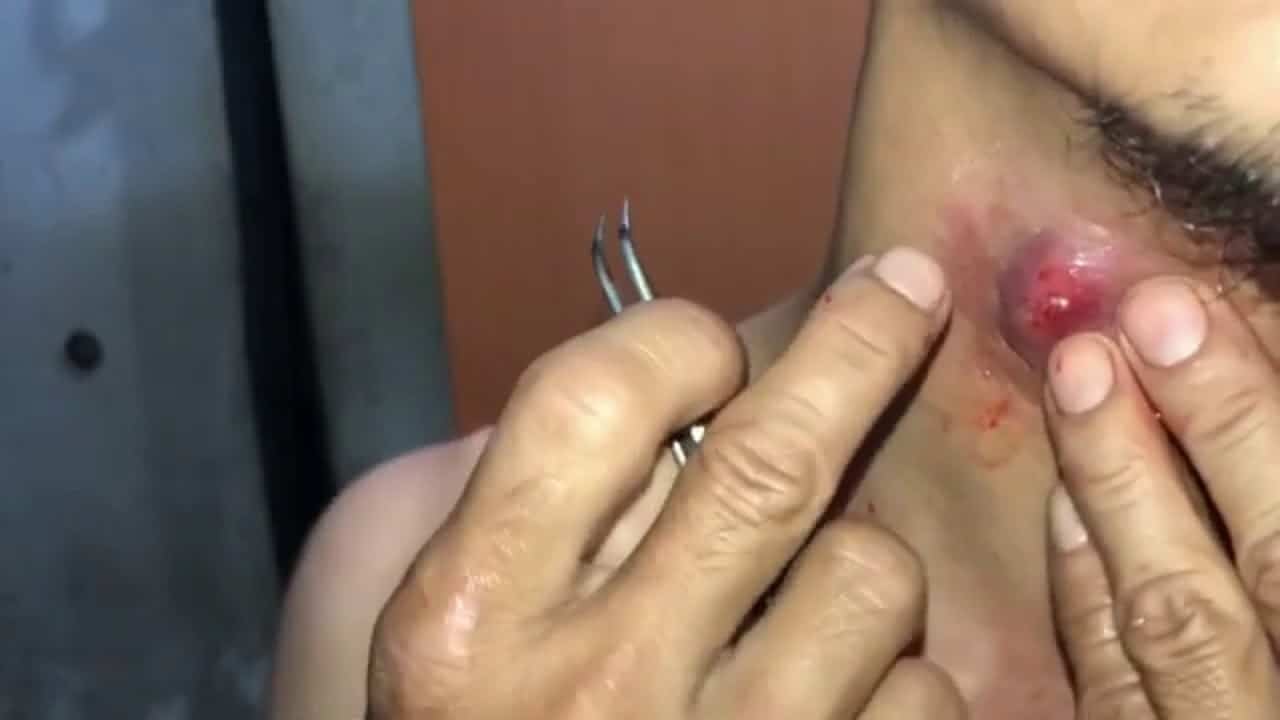 pimple popping ep1