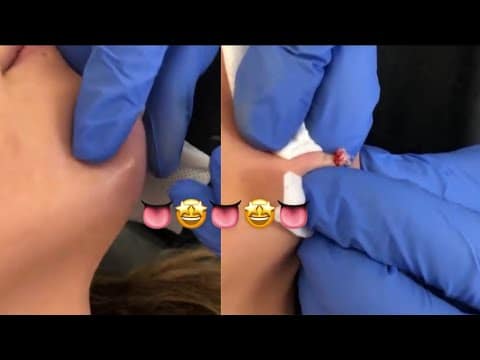 Pimple popping finger licking ??