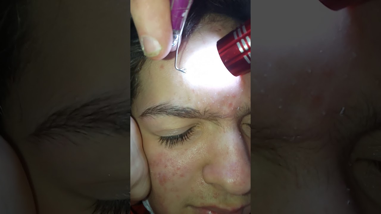 Pimple popping. First video attempting to pop and film.
