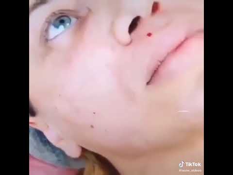 Pimple Popping in mouth… (So satisfying)