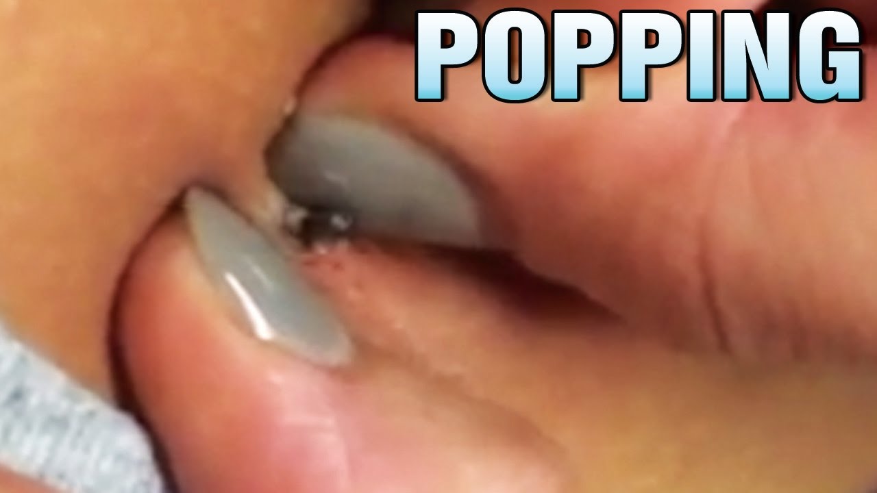 Pimple Popping, Ingrown Hair, Blackheads!  Medical Channel Trailer