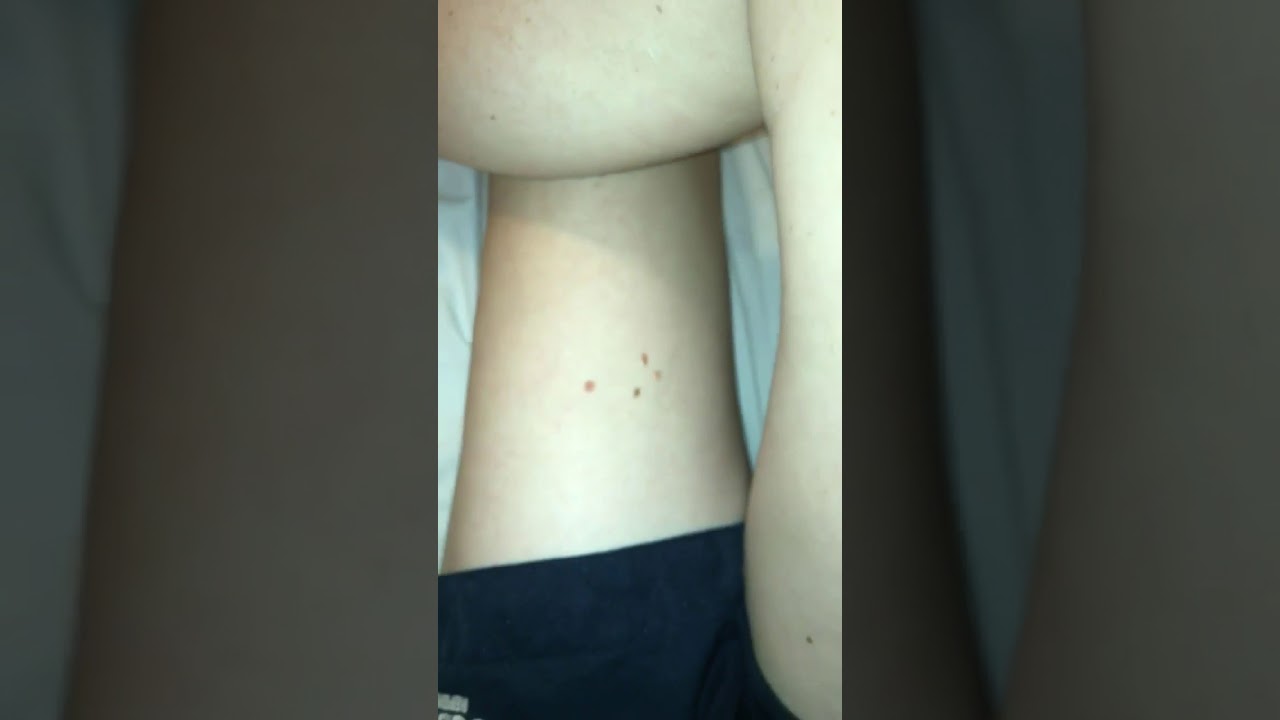 Pimple Popping Knee
