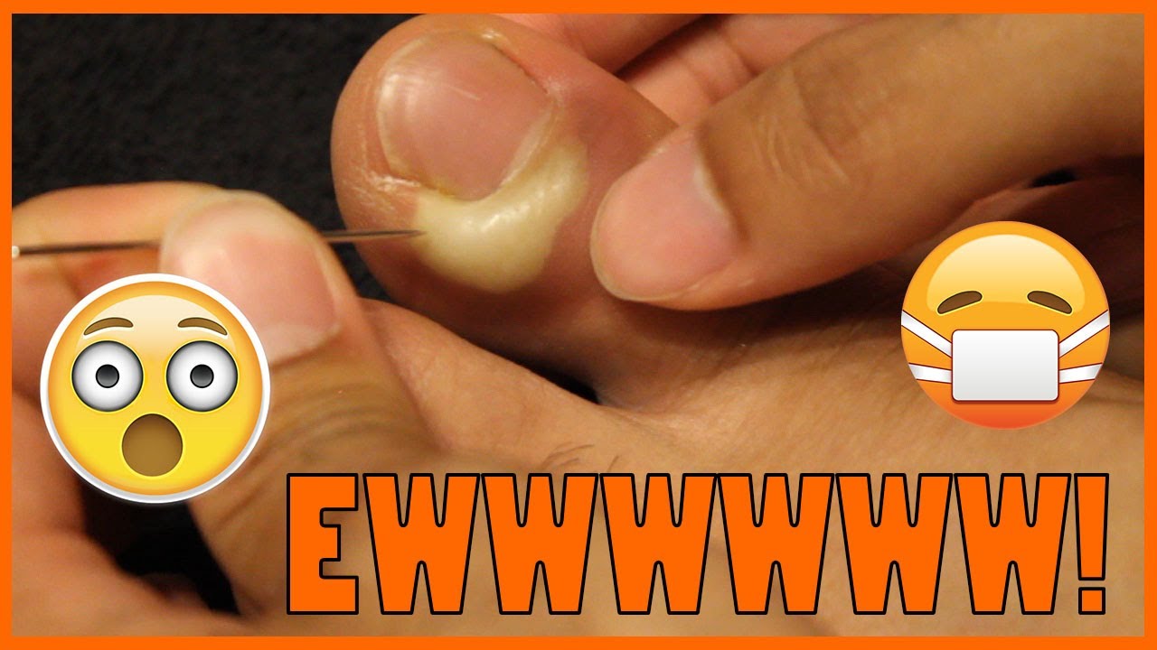PIMPLE POPPING MY INFECTED TOE! BEST ONE! (PARONYCHIA)