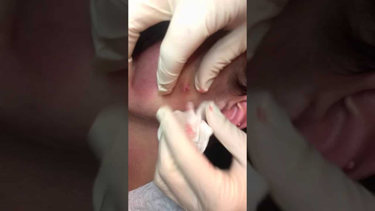 Pimple Popping on a cyst at Laser Lipo and Vein Center