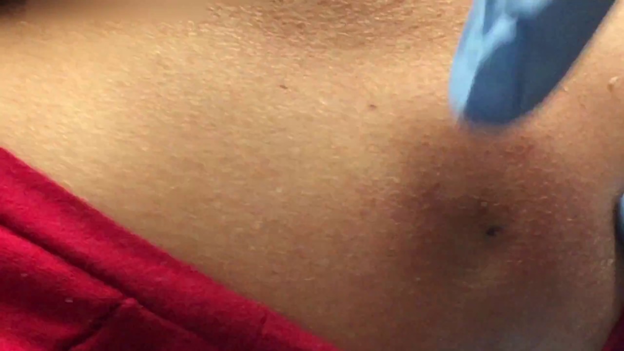 PIMPLE POPPING ON BACK PART2