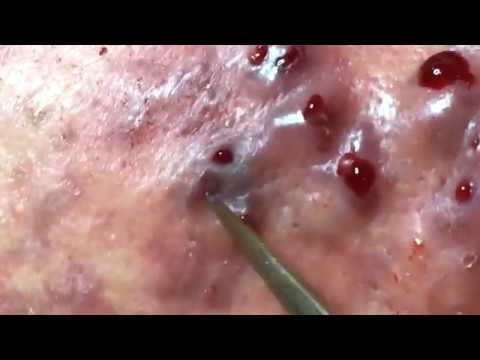 Pimple Popping on face|Remove Cystic on face