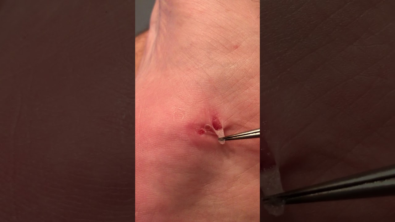 Pimple popping on foot