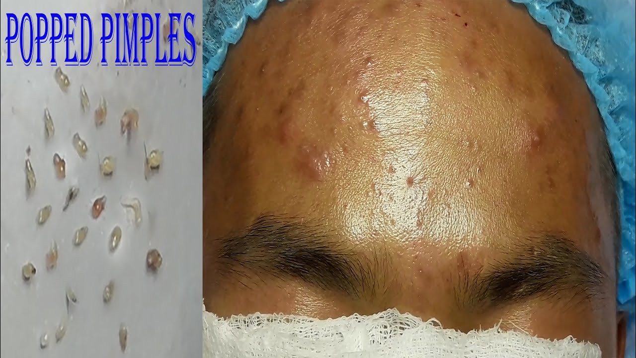 Pimple Popping on FOREHEAD ~ Satisfying Video Face Skin Care