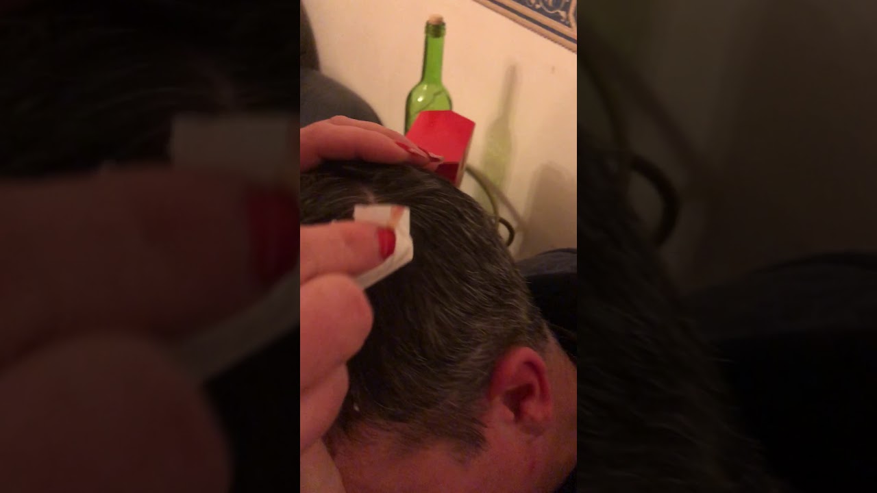 Pimple popping on head with amazing popping sound!!