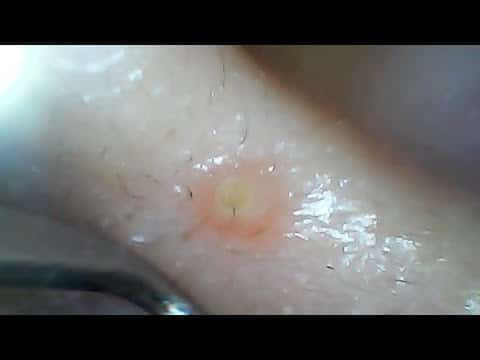 pimple popping! pimple picking!