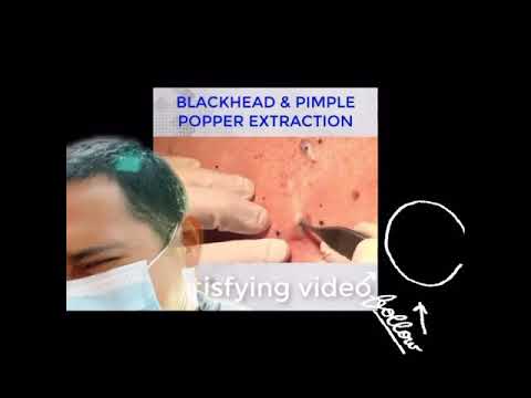 Pimple popping Reaction Video. Follow for more awesome videos!!✌️✌️???