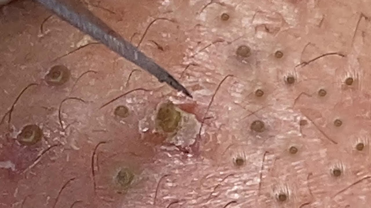 Pimple Popping   Remove Cystic