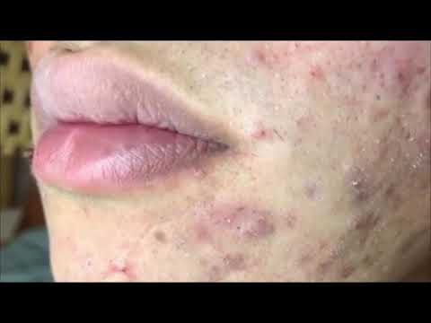 Pimple, Popping, Removing Blackheads around eyes and mouth, Bigger Blackhead , on the face, acne 178
