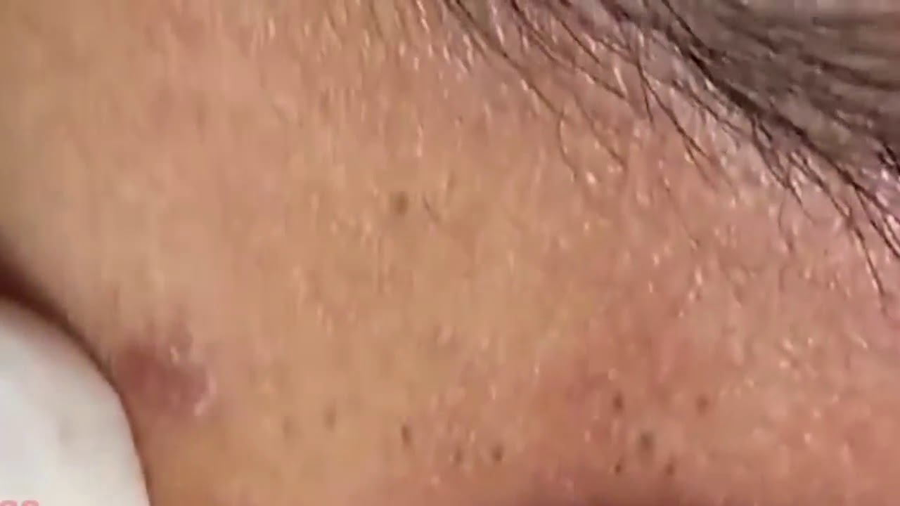 Pimple, Popping, Removing Blackheads, Bigger Blackhead ,on The Face, acne 135