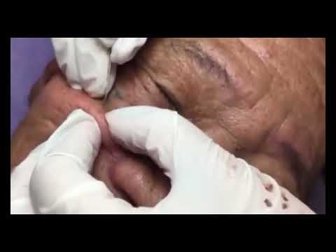 Pimple, Popping, Removing Blackheads, Bigger Blackhead ,on The Face, acne 8