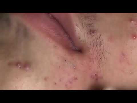 Pimple, Popping, Removing Blackheads, around eyes and mouth, Bigger Blackhead  on the face, acne 167