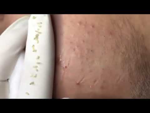 Pimple, Popping, Removing Blackheads around eyes and mouth, Bigger Blackhead , on the face, acne 165