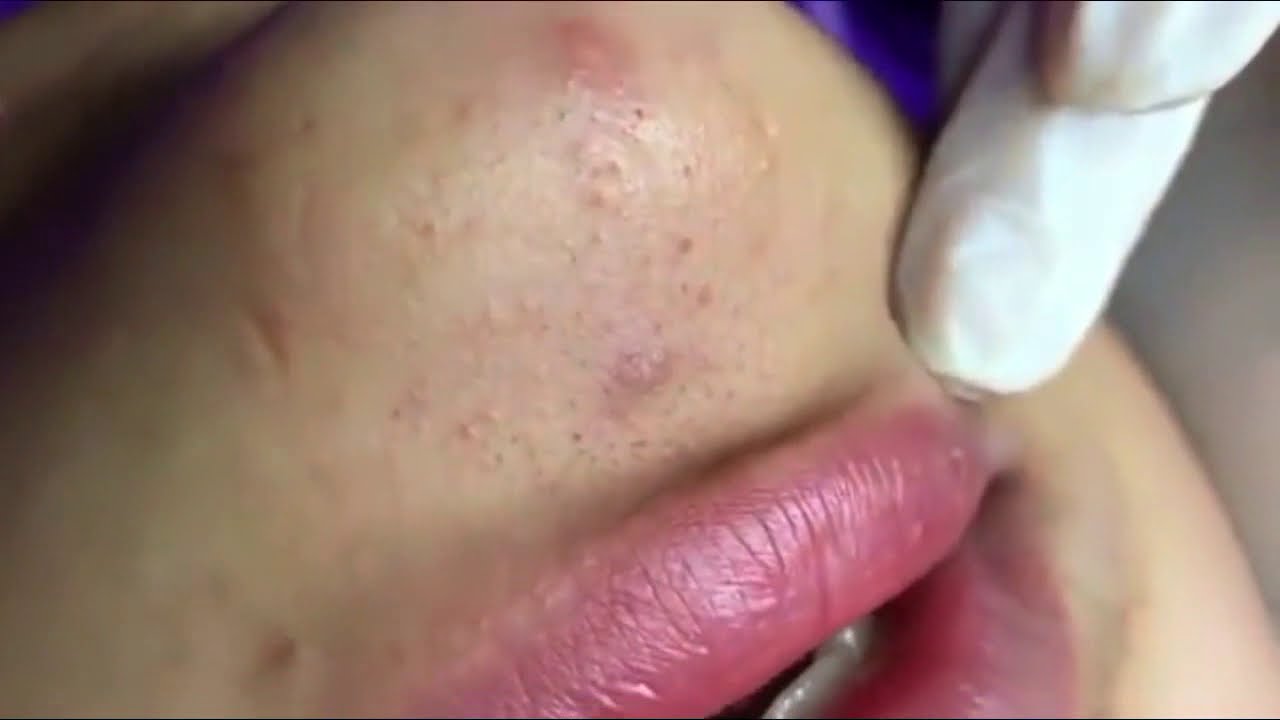 Pimple, Popping, Removing Blackheads around mouth, Bigger Blackhead , acne 143