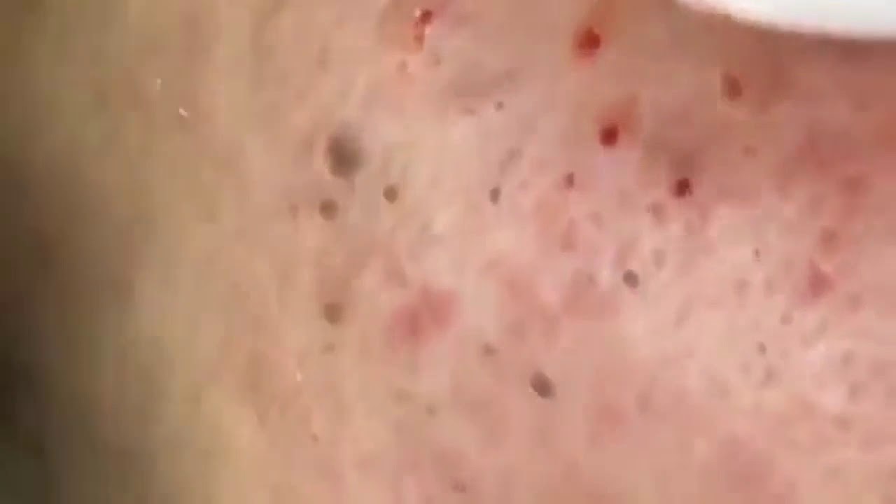Pimple, Popping, Removing Blackheads on the face, acne 159