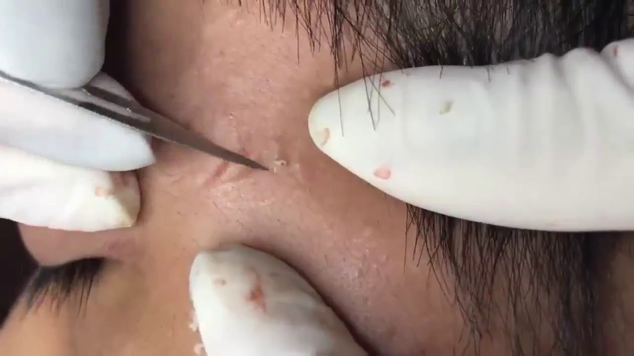 Pimple, Popping, Removing Blackheads around eyes and mouth, Bigger Blackhead , on the face, acne 142