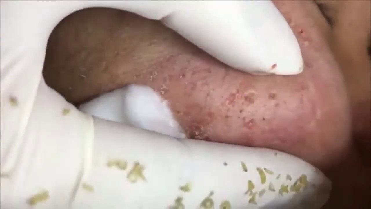 Pimple, Popping, Removing Blackheads around eyes and mouth, Bigger Blackhead , on the face, acne140