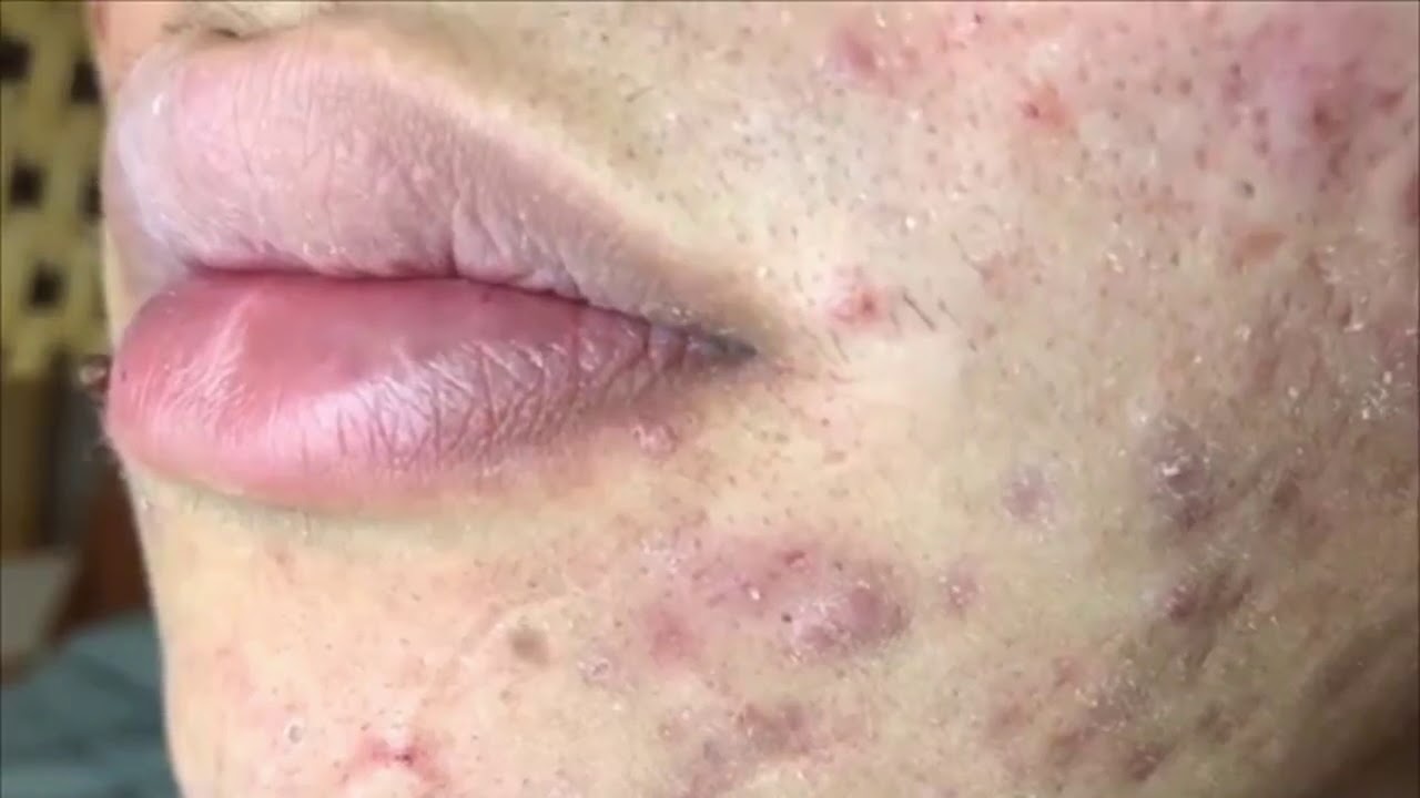 Pimple, Popping, Removing Blackheads, Bigger Blackhead , on the face, acne 138