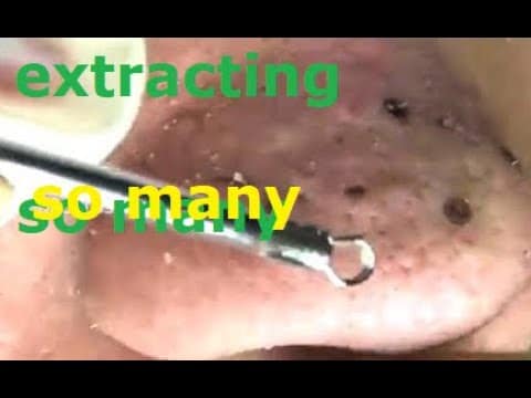 Pimple, Popping, Removing Blackheads around eyes and mouth, Bigger Blackhead , on the face, acne