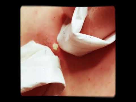 Pimple popping satisfaction! [Viral video]