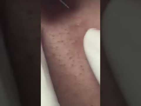 Pimple popping (satisfying)