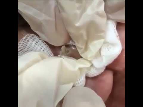 Pimple popping satisfying