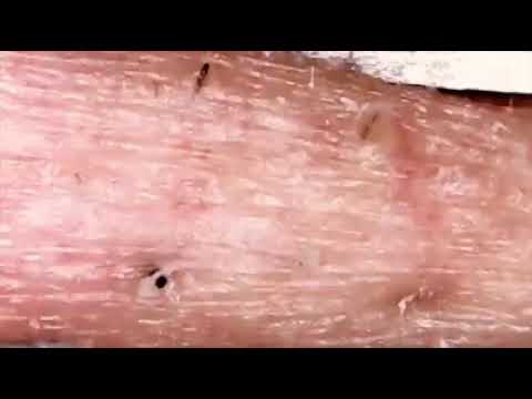 Pimple popping stress relief satisfaction