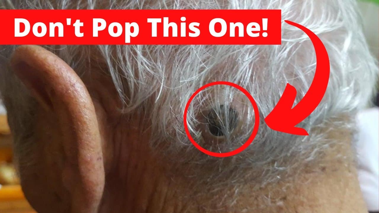 Pimple Popping – The MOST painful Pimple Popping videos you shouldn't pop without gloves