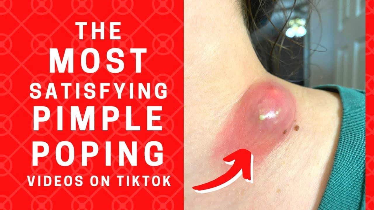 Pimple Popping – The Most Satisfying Pimple Popping Videos we Found on Tiktok