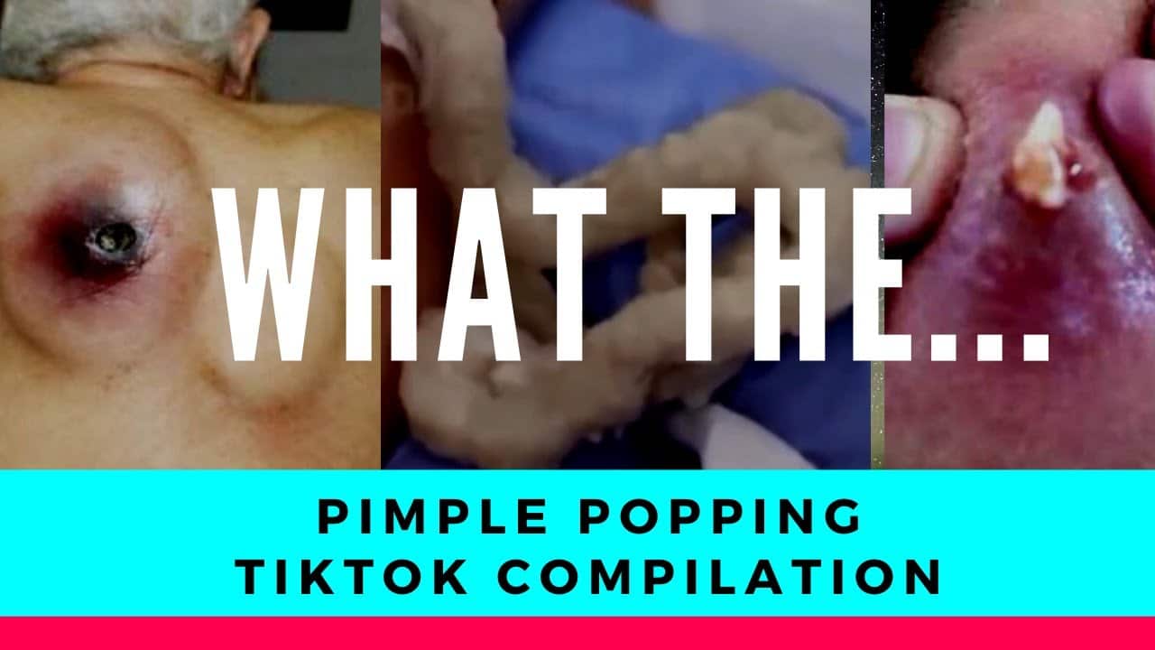 Pimple Popping TikTok Compilation [Try Not to THROW UP!]