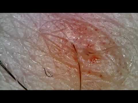 Pimple Popping under Microscop! 1000x Zoom