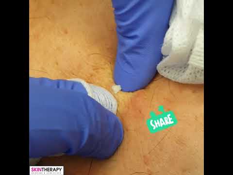 Pimple Popping Video!