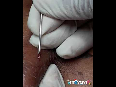 Pimple popping video