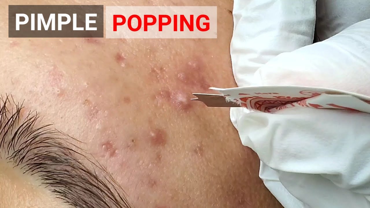 PIMPLE POPPING VIDEO