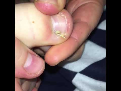 Pimple popping videos