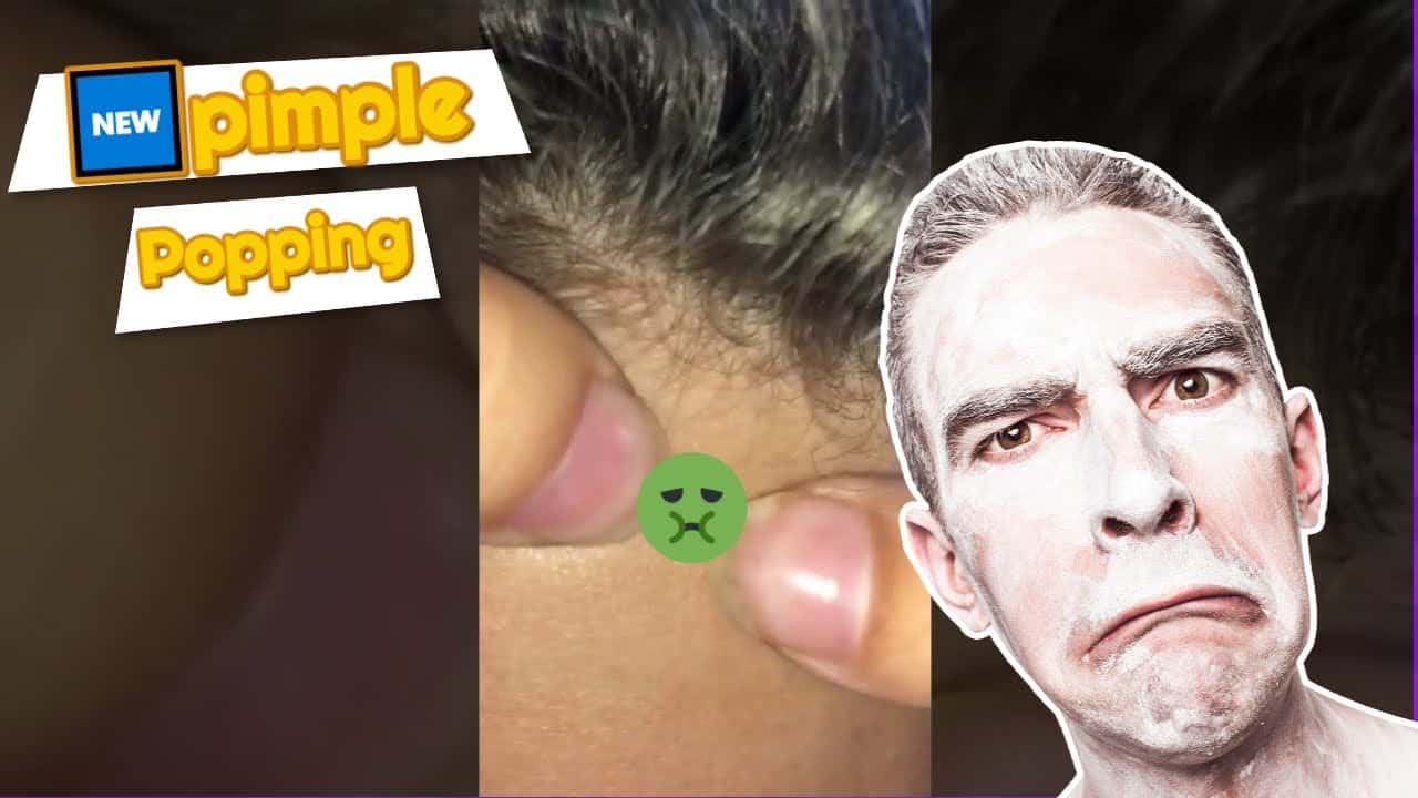 ?pimple Popping Videos 2020 Blackheads ➡ How To Get Rid Of Blackheads Honest Video Acne 76