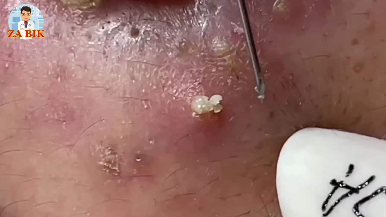 Pimple Popping Videos – Blackhead extraction Facebook – Watch or … EP.26